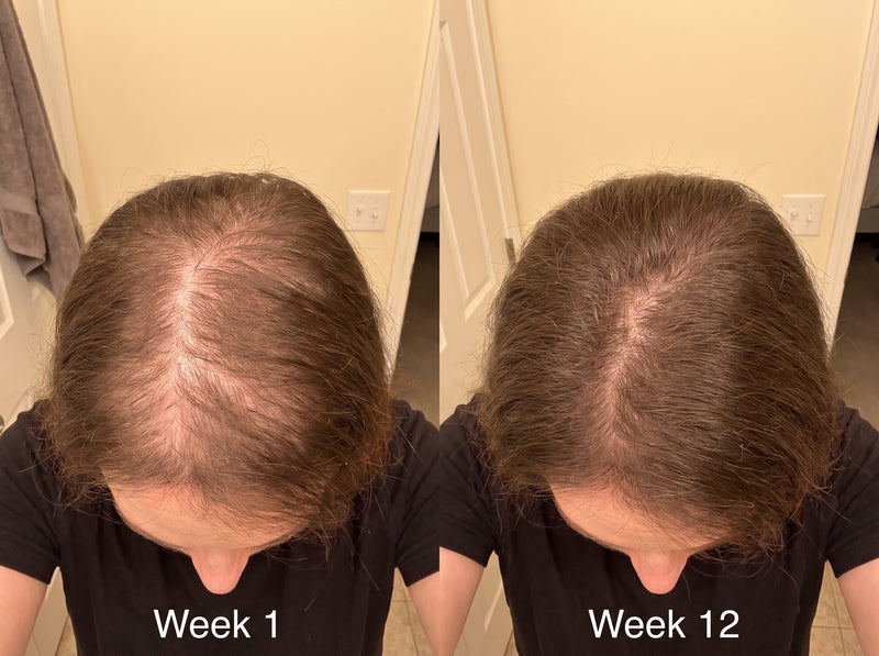 My labs were normal and my hair still fell